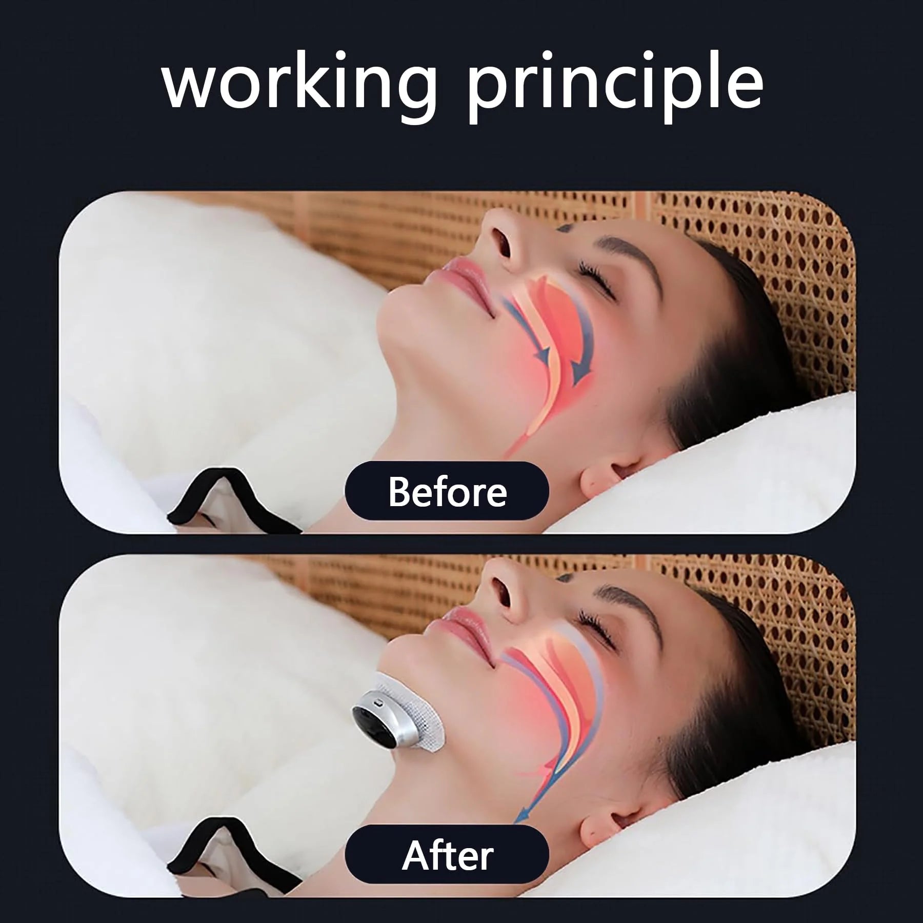Anti Snoring Device